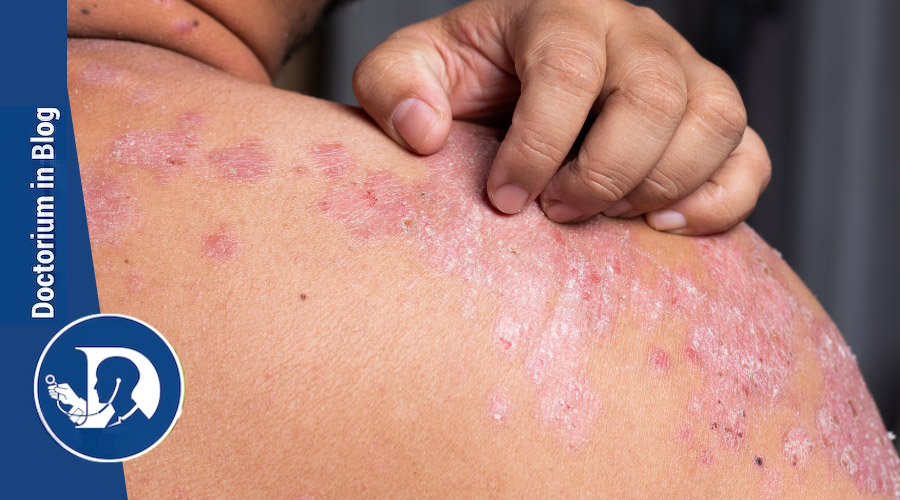 Dermatite atopica: ogni paziente costa 4.284 euro/anno